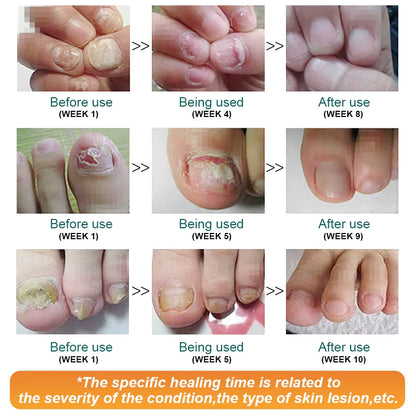 🦶 Kanyehb Fungal Nail Treatment – Restore Nail Health Naturally (Nail Repair)