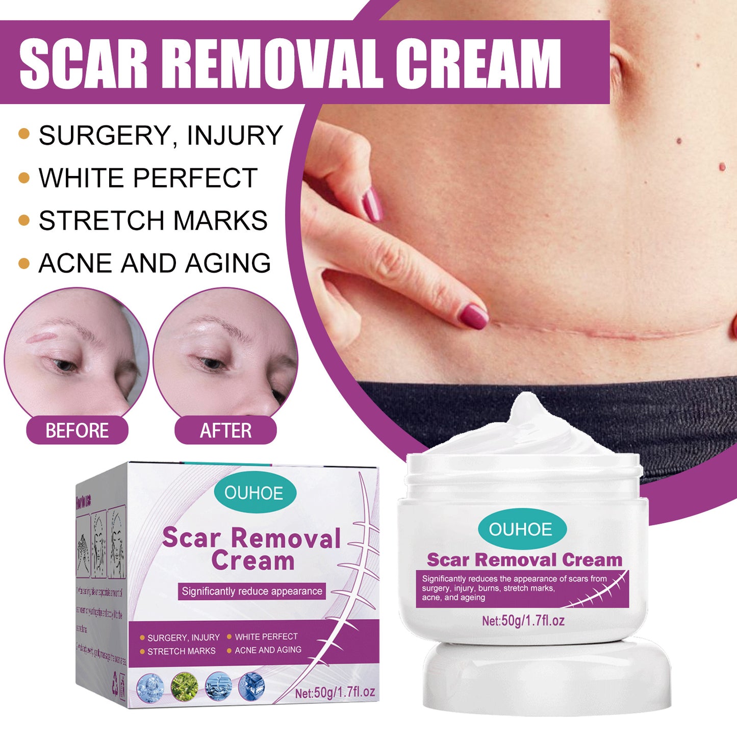 Hot Sale Scar Removing Cream Treating and Repair All Kinds of Old Scars