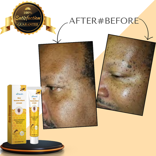 Highly Effective Skin Tag, Warts Removal Bee Venom Cream Wart Mole Remover Cream Dark Spot Removing Cream apply it 2 times daily