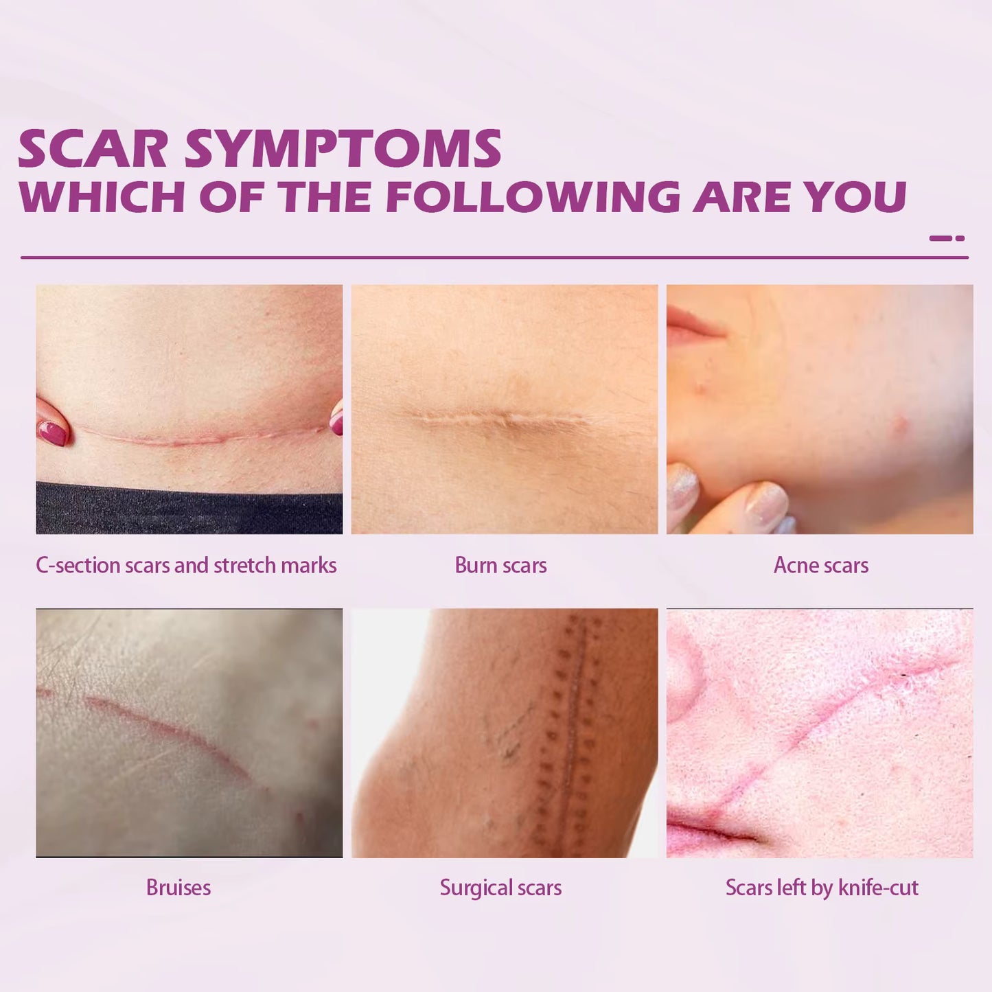 Hot Sale Scar Removing Cream Treating and Repair All Kinds of Old Scars