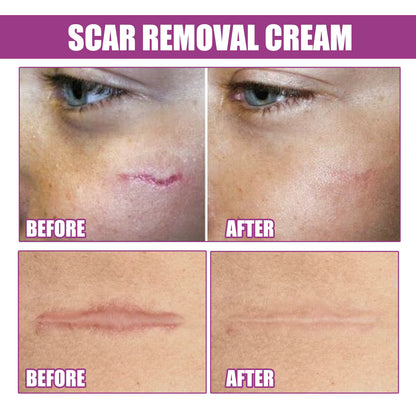 Hot Sale Scar Removing Cream Treating and Repair All Kinds of Old Scars